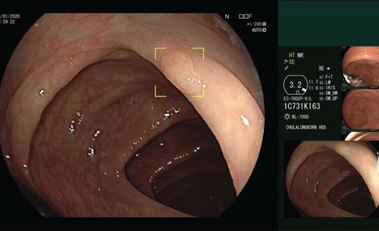 AI-Assisted GI Endoscopy Transforms Colorectal Cancer Detection