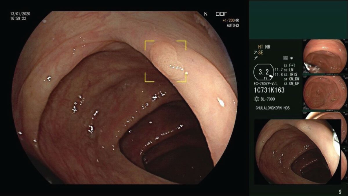 AI-Assisted GI Endoscopy Transforms Colorectal Cancer Detection