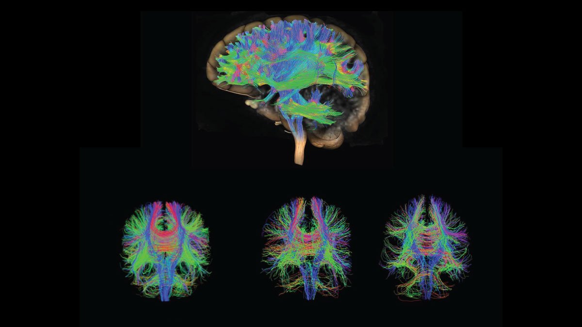 Advanced MRI Scans Detect Hidden Disease in Concussion Patients