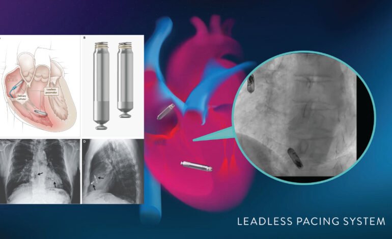 Wireless Pacemaker Prove Game-Changing Reliability in Latest Clinical Study