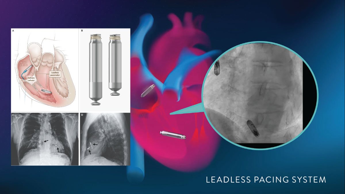 Wireless Pacemaker Prove Game-Changing Reliability in Latest Clinical Study