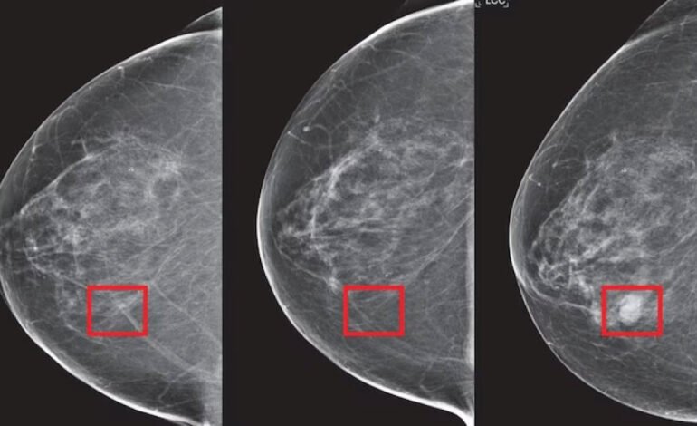 Mirai AI by MIT Predicts Breast Cancer 5 Years Ahead: A Technological Leap in Early Detection