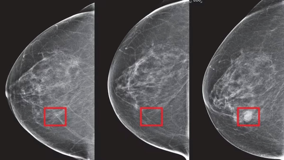 Mirai AI by MIT Predicts Breast Cancer 5 Years Ahead: A Technological Leap in Early Detection