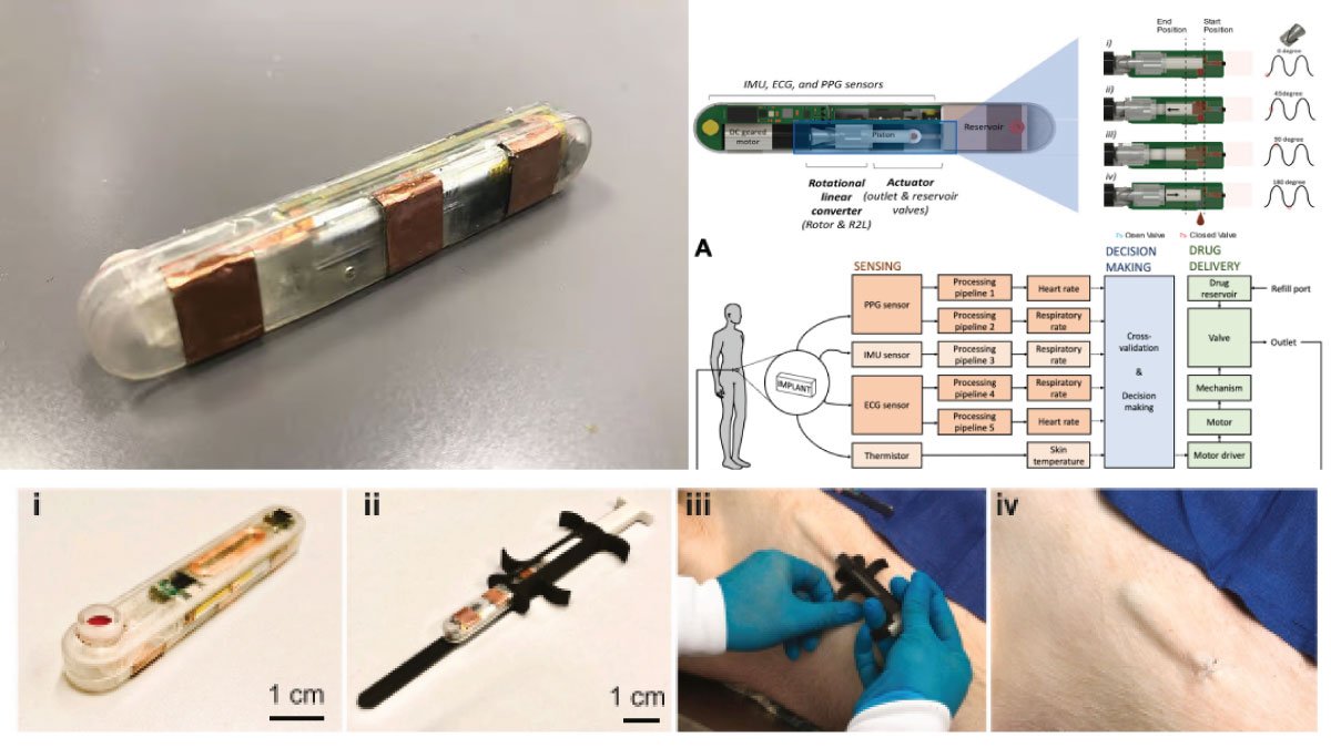 Reversing Opioid Overdoses with New Implantable Sensor