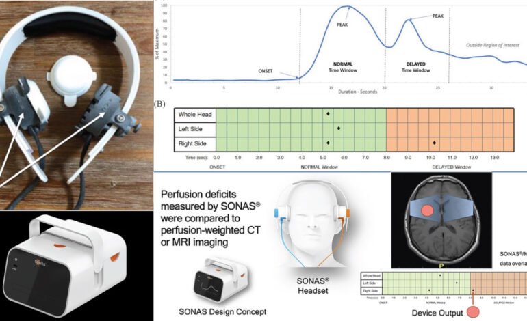 SONAS Ultrasound Device Transforms Cerebral Perfusion Assessment in Acute Stroke