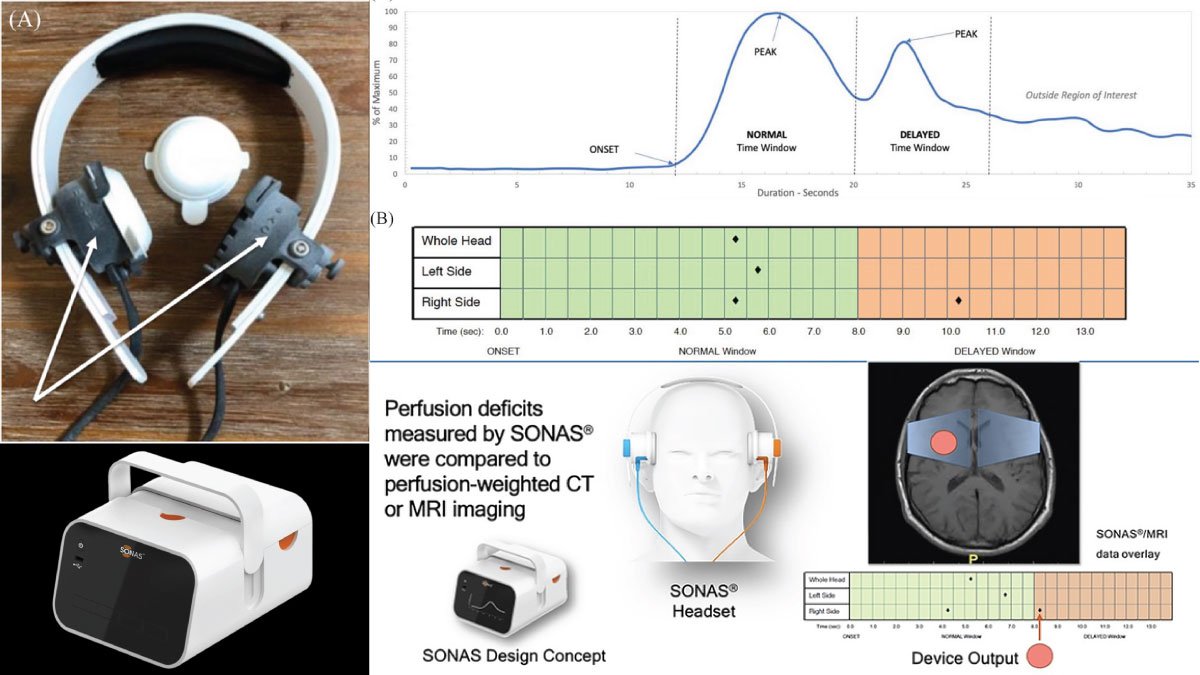 SONAS Ultrasound Device Transforms Cerebral Perfusion Assessment in Acute Stroke