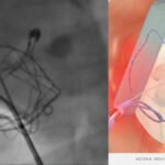 Interatrial shunt for heart failure