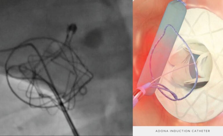 Interatrial Shunt for Heart Failure: Adona Medical Launches First-in-Human Study