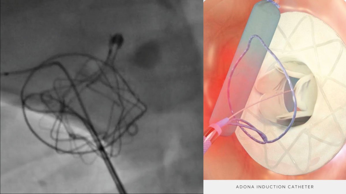 Interatrial Shunt for Heart Failure: Adona Medical Launches First-in-Human Study